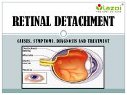 Retinal Detachment: Causes, Symptoms, Diagnosis and Treatment.