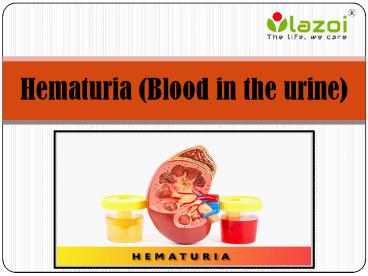 Hematuria (Blood in the urine): Symptoms, causes, diagnosis and treatment.