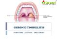 Chronic Tonsillitis: Symptoms, causes and treatment PowerPoint PPT Presentation