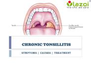 Chronic Tonsillitis: Symptoms, causes and treatment