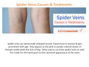 Spider Veins Causes & Treatments