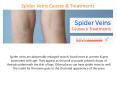 Spider Veins Causes & Treatment PowerPoint PPT Presentation