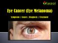 Eye Cancer (Eye Melanoma): Symptoms, Causes, Diagnosis and Treatment. PowerPoint PPT Presentation
