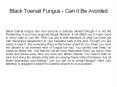 Black Toenail Fungus - Can it Be Avoided PowerPoint PPT Presentation