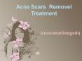 ACNE SCARS REMOVAL TREATMENT IN HYDERABAD, SCAR REMOVAL TREATMENT IN HYDERABAD – Anoosmadinaguda PowerPoint PPT Presentation