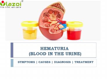 Hematuria (Blood in the urine): Symptoms, causes, diagnosis and treatment