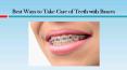 Best Ways to Take Care of Teeth with Braces PowerPoint PPT Presentation