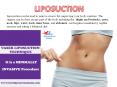 Liposuction : Liposuction Cosmetic Surgery in Delhi, INDIA PowerPoint PPT Presentation