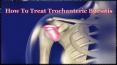 Trochanteric bursitis in Melbourne PowerPoint PPT Presentation