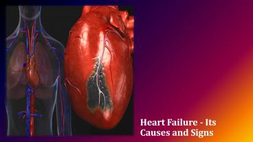 Heart Failure - Its Causes and Signs