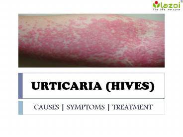 Urticaria (Hives) : causes, symptoms and treatments