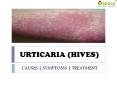 Urticaria (Hives) : causes, symptoms and treatments PowerPoint PPT Presentation