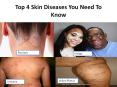 Top 4 Skin Diseases you need to know PowerPoint PPT Presentation
