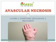 AVASCULAR NECROSIS : CAUSES, SYMPTOMS, DIAGNOSIS AND TREATMENT