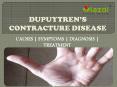 Dupuytren’s Contracture Disease : causes, symptoms and treatment PowerPoint PPT Presentation