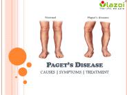 Paget’s disease : causes, symptoms, diagnosis and treatment