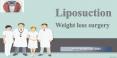 Liposuction Weight Loss Treatment in New York PowerPoint PPT Presentation