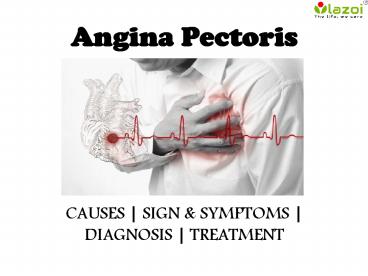 Angina pectoris : causes, symptoms, diagnosis and treatment