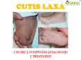 Cutis Laxa : Causes, symptoms, diagnosis, treatment and prevention PowerPoint PPT Presentation