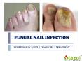 Fungal Nail Infection: causes, symptoms, diagnosis and treatment PowerPoint PPT Presentation