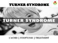 Turner syndrome : causes, symptoms and treatment PowerPoint PPT Presentation