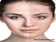 Know about the Skin problems and the cause @ LiveHomeo PowerPoint PPT Presentation