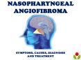 Nasopharyngeal Angiofibroma: Symptoms, causes, diagnosis and treatment PowerPoint PPT Presentation