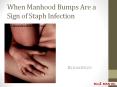 When Manhood Bumps Are a Sign of Staph Infection PowerPoint PPT Presentation