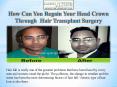 How Can You Regain Your Head Crown Through  Hair Transplant Surgery PowerPoint PPT Presentation