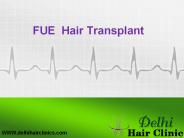 FUE hair transplant