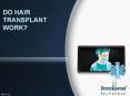 Do Hair Transplant Work? PowerPoint PPT Presentation