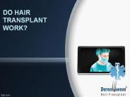 Do Hair Transplant Work?