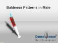 Types Of Baldness in Male PowerPoint PPT Presentation