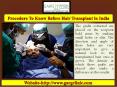Procedure To Know Before Hair Transplant in India