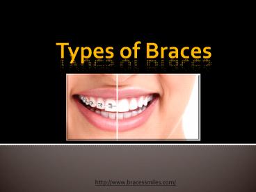 Types of Braces by Braces & Smiles Orthodontic and Dental Care Dentist ...