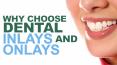Why Choose Dental Inlays and Onlays PowerPoint PPT Presentation