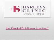 How Chemical Peels Remove Scars Caused By Acne?