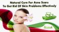 Natural Cure For Acne Scars To Get Rid Of Skin Problems Effectively PowerPoint PPT Presentation