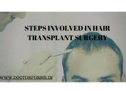Steps Involved in Hair Transplant Surgery