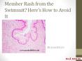 Member Rash from the Swimsuit? Here’s How to Avoid It PowerPoint PPT Presentation