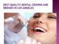 Best Teeth whitening in Los Angeles – Get that beautiful smile back. PowerPoint PPT Presentation