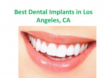 Best Dental Implants in Los Angeles, CA