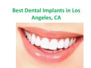 Best Dental Implants in Los Angeles, CA