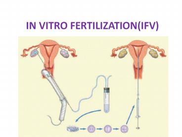 IN VITRO FERTILIZATION(IFV)