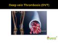 Deep vein Thrombosis (DVT) PowerPoint PPT Presentation
