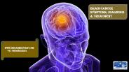 Brain Cancer-Symptoms,Diagnosis & Treatment