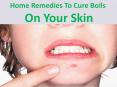 Home remedies to cure boils on your skin PowerPoint PPT Presentation