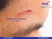 Stretch marks and Accident marks removal By Teja's