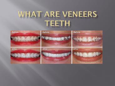 how much do porcelain veneers cost