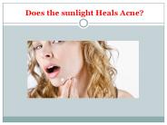  Does the sunlight Heals Acne?